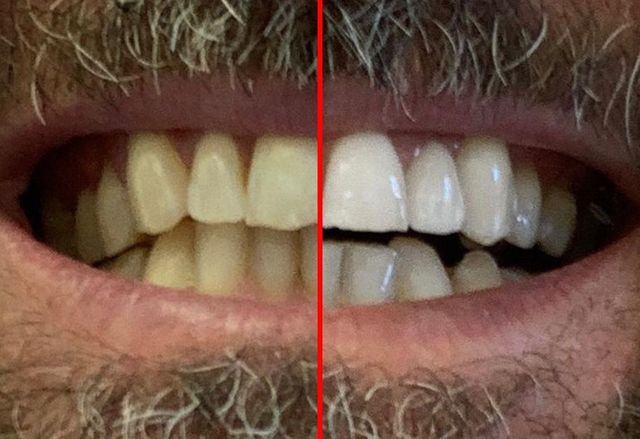 Sbiancamento Dentale